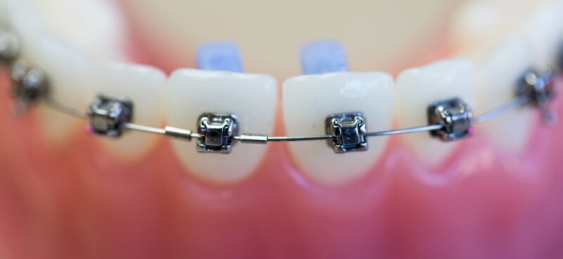 Blog -Hazelwood Dental