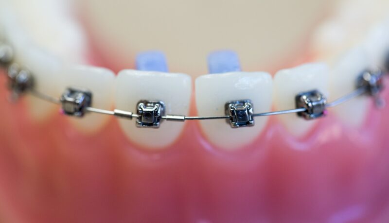 Blog inner thumb : Hazelwood Dental