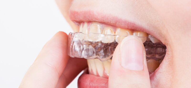 Blog -Hazelwood Dental