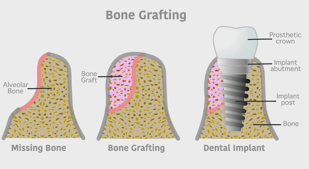 Treatment Inner Image - Hazelwood Dental